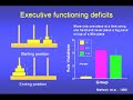 Fetal Alcohol Syndrome &amp; Fetal Alcohol Effects Video Part 2