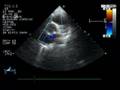 pulmonary hypertension jinay