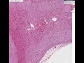 Histopathology Adrenal--Cortical adenoma Histopathology Adrenal--Cortical adenoma