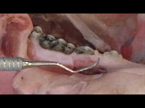Практикум по пластике мягких тканей десны в области зубов и имплантатов. Часть 4