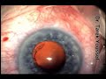 This hypertensive, diabetic, obese patient with advanced resistant Pseudoexfoliation glaucoma had rapid shollowing of the AC during an uneventful phacoemulsification. Needed to rapidly implant the IOL and close the would, do an anterior vitrectomy followed by pars plana vitrectomy to decompress the vitreeous cavity and remove the vitreous from the wound. He is now has an UCVA of 20/40 with well controlled IOP.