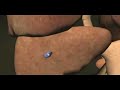 Introduction to Cancer Biology