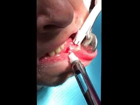 how to drain tooth abscess at home