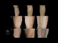 Role of VeinViewer on Guiding Laser to Treat Feeder Veins
