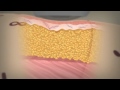 Liposonix is the latest in non invasive body contouring cosmetic procedures.