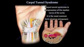 Carpal Tunnel Syndrome - Everything You Need To Know - Dr. Nabil Ebraheim