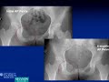 Zoledronate Treatment of Benign Bone Tumors