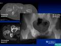 Zoledronate Treatment of Benign Bone Tumors
