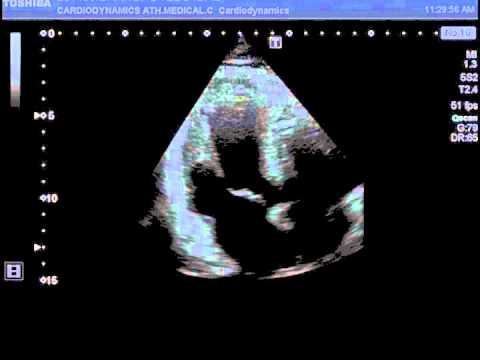 how to treat lv thrombus