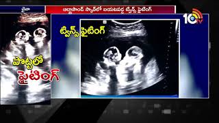 Unborn Twins spotted fighting inside Mother’s Womb | Social Media Viral Videos