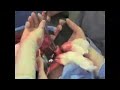 Dr. James Wittig: Radical Resection of Distal Femur [Part 3]