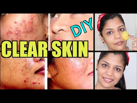 DIY Facemask for Acne Treatment | Get Clear & Bright Skin