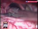 MyFox Los Angeles Doctors Find Worm in Woman\ MyFox Los Angeles Doctors Find Worm in Woman\