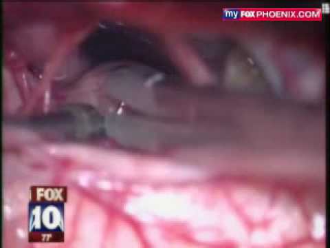 how to discover brain tumor