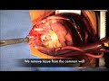 Coronary Artery Anomaly Repair: Preventing Sudden Death Coronary Artery Anomaly Repair: Preventing Sudden Death