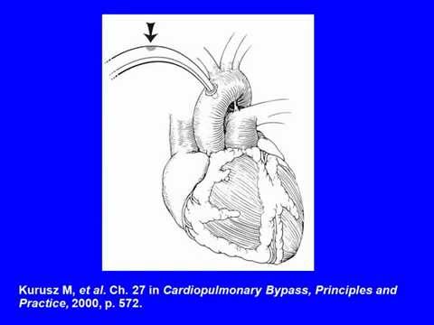 how to treat air embolism