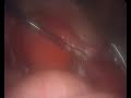 Laparoscopic Salpingectomy for Ectopic Pregnancy