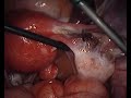 Laparoscopic Salpingectomy for Ectopic Pregnancy