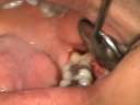 tercera molar incluida tercera molar incluida