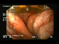 Barrett's Esophagus - Halo 90 Endoscopic Therapy Barrett's Esophagus - Halo 90 Endoscopic Therapy