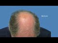 Hair Transplant Result - 4800 Grafts 1 Session - Doctor Wong
