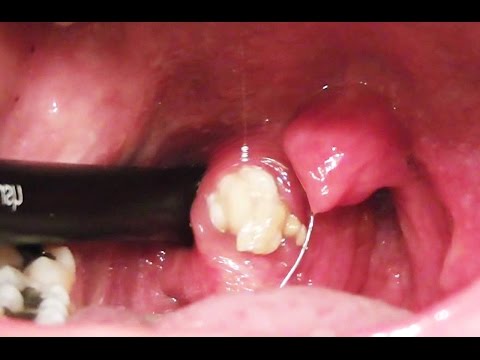 how to remove tonsil stones