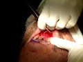 Implant and bone graft with collagen membrane #3
