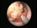 Prostate Endoscopic Vaporesection - Continuous Wave 2 µm Laser Prostate Endoscopic Vaporesection - Continuous Wave 2 µm Laser