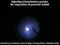 Vitrectomy for Macular hole Reg no 27.2009