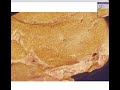 Histopathology Liver -- Fatty change