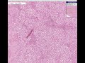 Histopathology Liver -- Fatty change