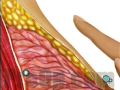 Breast Biopsy Incisional Surgery