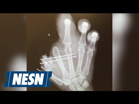Video: Jason Pierre-Paul Shows Off X-Ray Of Mangled Hand