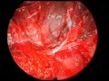Adenoma Of A Pituitary Gland Adenoma Of A Pituitary Gland