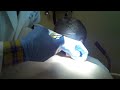 Cyst - Part 2.3gp