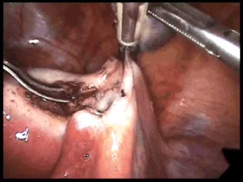 how to cure ectopic pregnancy