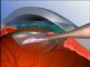 Washinton DC Cataract Surgery with ReSTORŪ and ReZoom? Washinton DC Cataract Surgery with ReSTORŪ and ReZoom?