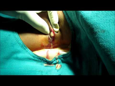 how to drain axillary abscess