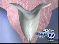 Healthbeat - Hysterectomy Alternatives