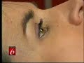 Fraxel Laser Skin Rejuvenation - Dr. Roger Bassin -Pt 1 of 2
