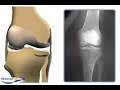 Osteotomy