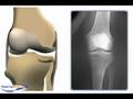 Osteotomy