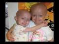 Progeria clinical drug trial