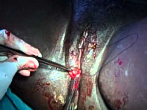 how to perform episiotomy suturing