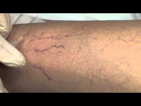how to cure spider veins
