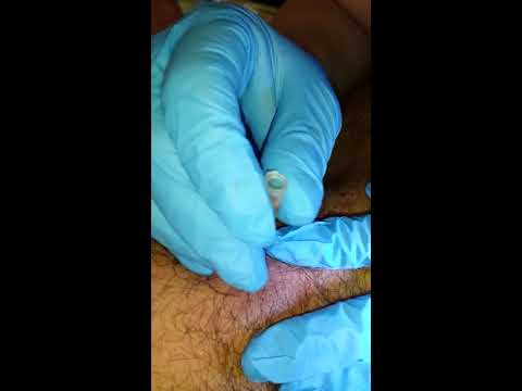 how to treat oozing pimple