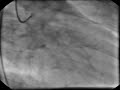 intracardiac catheter #2