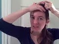 DALLAS HAIR TRANSPLANT DIARY: FEMALE HAIRLINE LOWERING PART2 DALLAS HAIR TRANSPLANT DIARY: FEMALE HAIRLINE LOWERING PART2