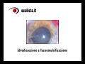 Cataratta: intervento di facoemulsificazione