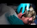 HUGE ZIT SLICED OPEN